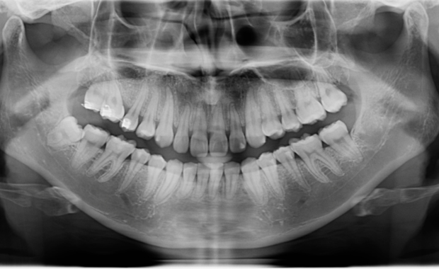 パノラマレントゲン