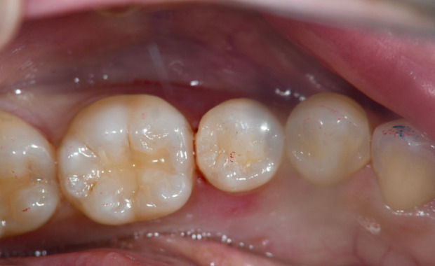 虫歯治療　術後