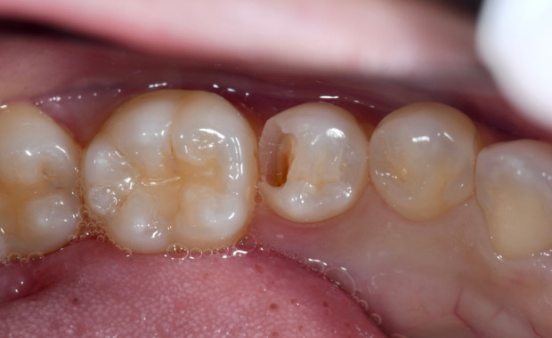 虫歯治療　術前