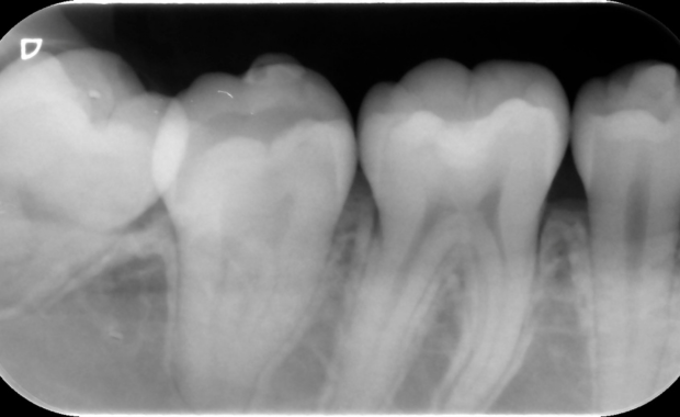 デンタルレントゲン
