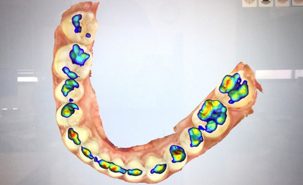 口腔内スキャナー